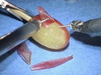 Ρομποτική ακρίβεια Da Vinci Xi. Παντελής Αντωνάκης, Ρομποτική & Λαπαροσκοπική Χειρουργική