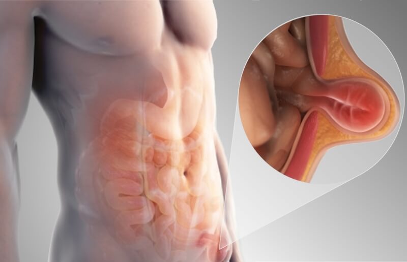 Βουβωνοκήλη λαπαροσκοπικά