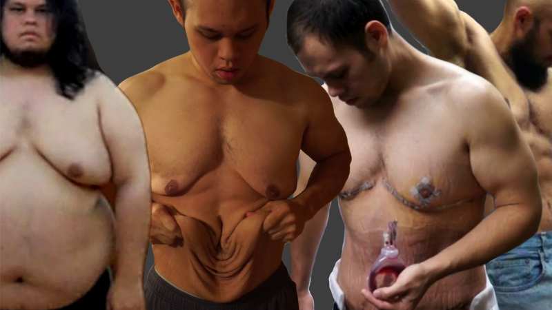 Παχυσαρκία