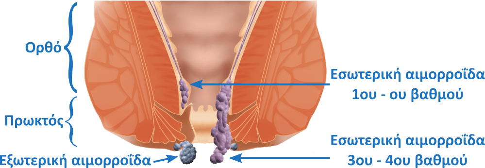 Κατάταξη αιμορροϊδοπάθειας, Χειρουργός Αντωνάκης MD PhD