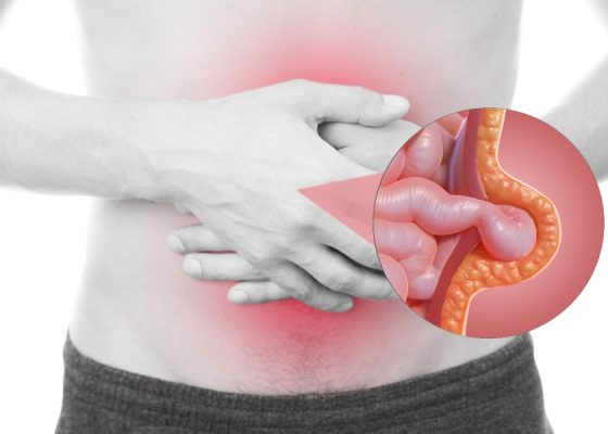 Σχηματική απεικόνιση ομφαλοκήλης